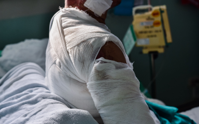 Burn Injuries
